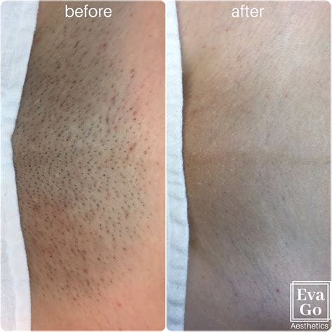 laser hair removal before and after bikini.